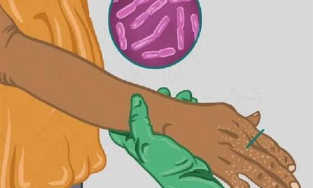 पंचायती राज संस्थाओं ने कुष्ठ उन्मूलन अभियान को जन- जन तक पहुंचाने का लिया संकल्प